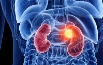 تعرف على العوامل الرئيسية وراء ارتفاع حالات سرطان الكلى