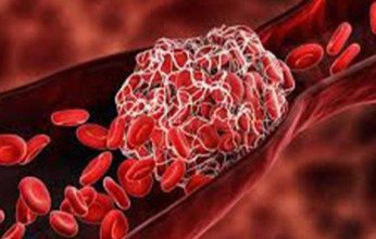 علماء روس يطورون نظام ذكاء اصطناعي لاكتشاف وتقييم مخاطر انفصال الخثرات الدموية