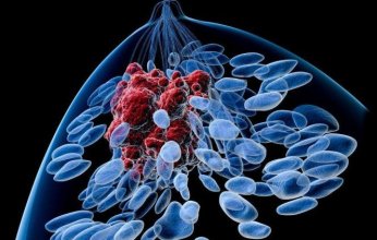 اختراق علمي يكشف سببًا جديدًا لسرطان الثدي الثلاثي السلبي لدى الشابات