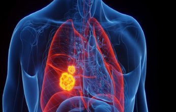 دراسة حديثة: "عامل خفي" في الهواء يسبب طفرات جينية تؤدي إلى سرطان الرئة لدى غير المدخنين