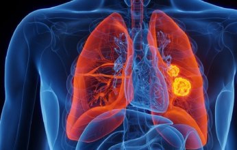 علماء يكتشفون طريقة فعّالة لعلاج سرطان الرئة ومواجهة مقاومته للأدوية