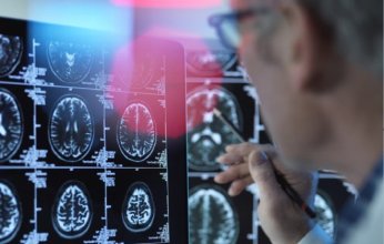 التلوث الهوائي.. خطر خفي يهدد الدماغ ويزيد من احتمالات الإصابة بالخرف