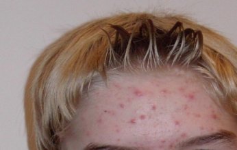 هل تعالج الشمس حب الشباب؟.. أخصائية جلدية تفند الاعتقاد الشائع