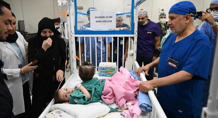 نجاح عملية فصل التوأم السيامي السوري «سيلين وإيلين» نجاح عملية فصل التوأم السيامي السوري «سيلين وإيلين»