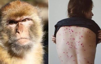 غينيا تتجاوز 300 إصابة مؤكدة بجدري القرود وسط حالة طوارئ صحية عامة