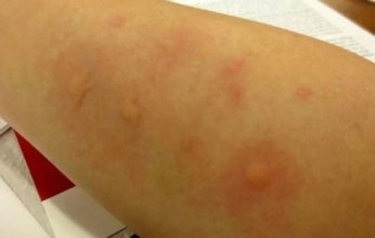 دراسة حديثة: تحليل الدم قد يقود إلى علاج مرضى حساسية الفول السوداني