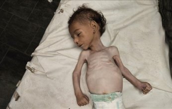 وفاة 21 طفلا خلال ثلاثة أيام بسبب سوء التغذية والمجاعة في قطاع غزة