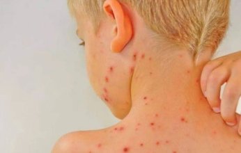 زعيم الأقلية الديمقراطية بمجلس الشيوخ يطالب بإعلان حالة طوارئ صحية في أمريكا بسبب تفشي الحصبة