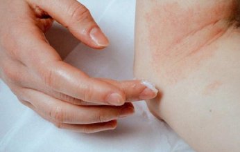 الطفح الجلدي قد يكشف عن أمراض خطيرة في الكبد أو الكلى أو الغدد