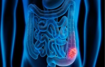 خطوات وأطعمة بسيطة قد تقيك من سرطان الأمعاء.. تعرف عليها