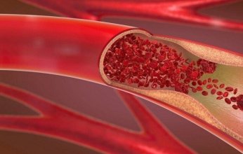 "تصلب الشرايين" المرض الصامت الذي يهدد القلب والدماغ