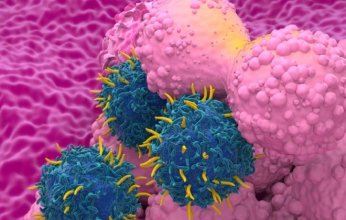 بداية واعدة.. أول علاج إشعاعي مبتكر لسرطان الثدي المتقدم في أمريكا