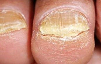 تشوه الأظافر.. الأسباب وطرق العلاج والوقاية