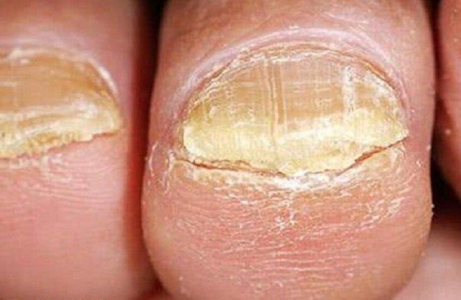 تشوه الأظافر.. الأسباب وطرق العلاج والوقاية تشوه الأظافر.. الأسباب وطرق العلاج والوقاية