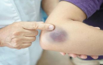 طبيب مصري يوضح أسباب وعلاج كدمات الزعل