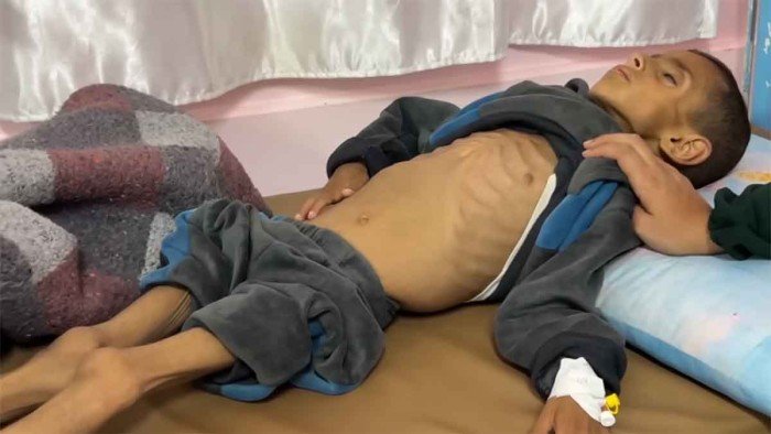 حصيلة ضحايا التجويع في قطاع غزة ترتفع إلى 251 بينهم 108 أطفال حصيلة ضحايا التجويع في قطاع غزة ترتفع إلى 251 بينهم 108 أطفال