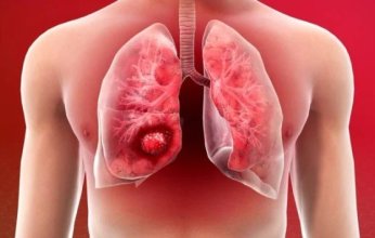علاج جديد يقلل من خطر الوفاة بسرطان الرئة