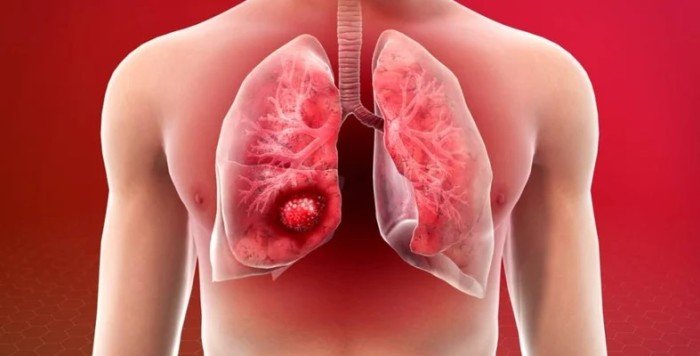 علاج جديد يقلل من خطر الوفاة بسرطان الرئة علاج جديد يقلل من خطر الوفاة بسرطان الرئة