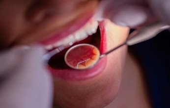 هل ينتقل تسوس الأسنان عبر التقبيل؟ طبيبة توضح الحقيقة