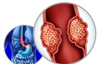ابتكار كبسولة تنظيرية ذكية لرصد سرطان المريء في مراحله المبكرة