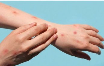 غينيا تتسلم 20 ألف جرعة من اللقاح المضاد لجدري القرود