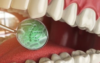بكتيريا الفم قد تكون عاملاً خفياً وراء الإصابة بالنوبات القلبية