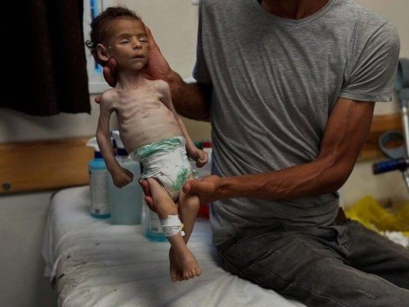 6 وفيات من بينها طفلان نتيجة المجاعة وسوء التغذية خلال الـ24 ساعة الماضية 6 وفيات من بينها طفلان نتيجة المجاعة وسوء التغذية خلال الـ24 ساعة الماضية