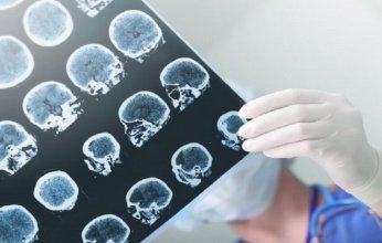 كيف تؤثر وجبة دسمة واحدة على دماغك؟ دراسة دولية توضح الأضرار