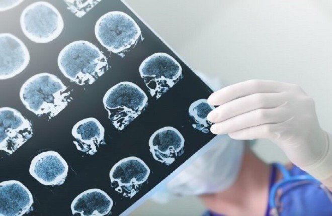 كيف تؤثر وجبة دسمة واحدة على دماغك؟ دراسة دولية توضح الأضرار كيف تؤثر وجبة دسمة واحدة على دماغك؟ دراسة دولية توضح الأضرار