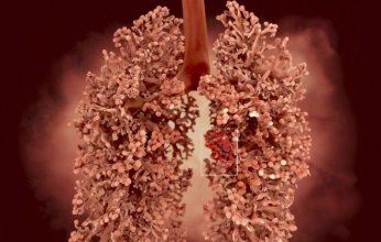 اكتشاف دواء جديد يبعث الأمل لمرضى سرطان الرئة الأكثر عدوانية