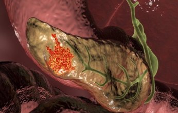 اكتشاف جزيء سكري قد يفتح آفاقاً جديدة لعلاج سرطان البنكرياس