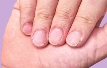 الأظافر مرآة الجسم.. 6 علامات تحذيرية تكشف مشكلات صحية خطيرة