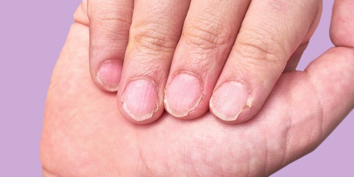 الأظافر مرآة الجسم.. 6 علامات تحذيرية تكشف مشكلات صحية خطيرة الأظافر مرآة الجسم.. 6 علامات تحذيرية تكشف مشكلات صحية خطيرة