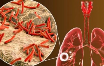 ابتكار طبي جديد لتشخيص مرض السل عبر هواء الزفير