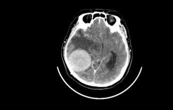 دراسة صادمة تكشف.. القلق والدوار قد يكونان إنذارًا مبكرًا لأورام الدماغ!