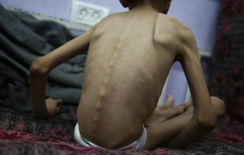 ارتفاع حصيلة ضحايا التجويع في قطاع غزة إلى 460 شهيدا