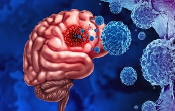 دراسة جديدة.. سرطان الدماغ يهاجم عظام الجمجمة ويعطل المناعة