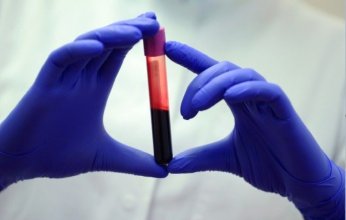 اختبار دم ثوري يشخّص متلازمة التعب المزمن بدقة تصل إلى 96%