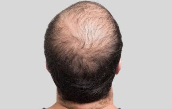 دواء لعلاج الصلع يهدد الصحة العامة ويقود إلى الاكتئاب والانتحار