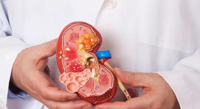 الصحة العالمية: تضاعف عدد المصابين بأمراض الكلى المزمنة عالميا منذ 1990