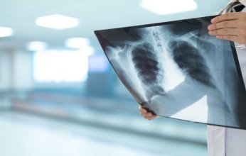 تجربة سريرية تكشف دواءً جديداً قد يُحدث تحولاً في علاج السل المقاوم للأدوية