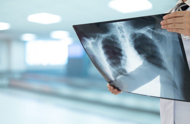 تجربة سريرية تكشف دواءً جديداً قد يُحدث تحولاً في علاج السل المقاوم للأدوية تجربة سريرية تكشف دواءً جديداً قد يُحدث تحولاً في علاج السل المقاوم للأدوية