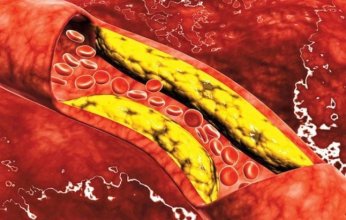 علاج للكوليسترول يقلل خطر الإصابة بأمراض القلب بنسبة 25%