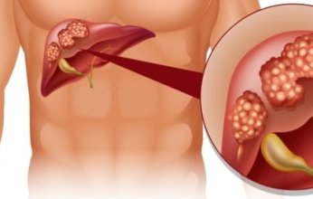 مكون منزلي شائع في منتجات التنظيف مرتبط بتليف وسرطان الكبد