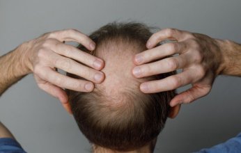 أمل جديد للرجال.. علاج ثوري يحقق قفزة غير مسبوقة في استعادة الشعر المفقود