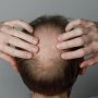 أمل جديد للرجال.. علاج ثوري يحقق قفزة غير مسبوقة في استعادة الشعر المفقود 2 khaligyoun36140