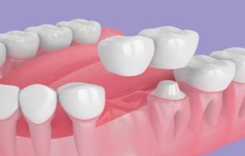 ابتكار روسي جديد قد يغني عن زراعة الأسنان ويخفض تكلفة العلاج للنصف