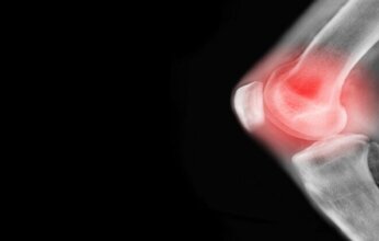 دراسة إسبانية تبشر بفرصة جديدة للوقاية من التهاب المفاصل الروماتويدي