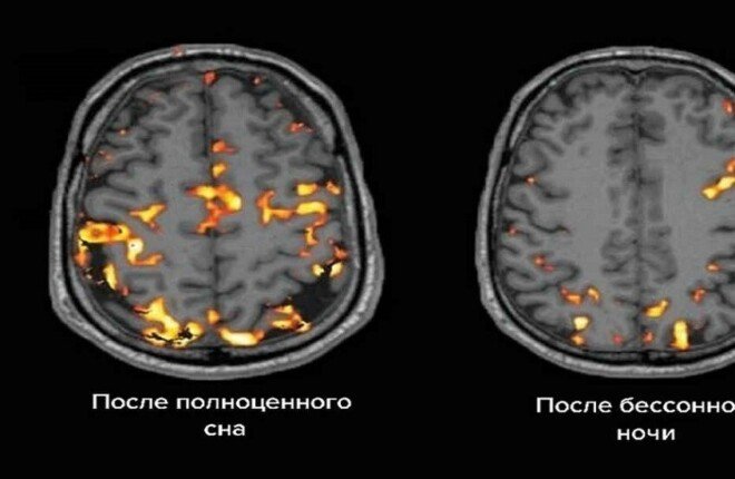 دراسة: اضطرابات النوم ترتبط بتسارع شيخوخة الدماغ وزيادة خطر الخرف دراسة: اضطرابات النوم ترتبط بتسارع شيخوخة الدماغ وزيادة خطر الخرف