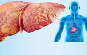 نهج جديد لعلاج الكبد الدهني.. إصلاح الأمعاء أولًا بدلًا من استهداف الكبد مباشرة